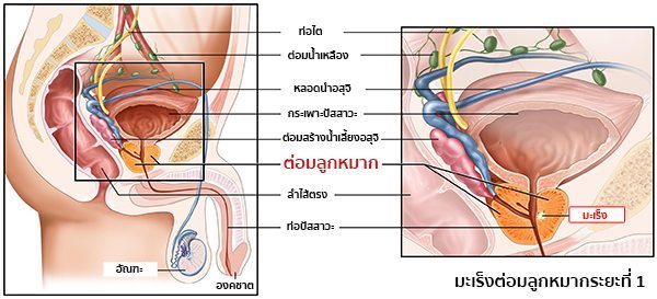 มะเร็งต่อมลูกหมากระยะแรก