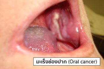 มะเร็งในช่องปาก