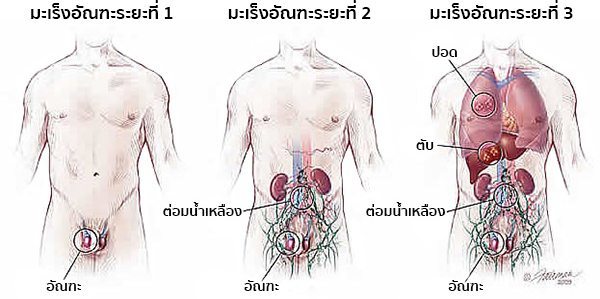 ระยะของโรคมะเร็งอัณฑะ