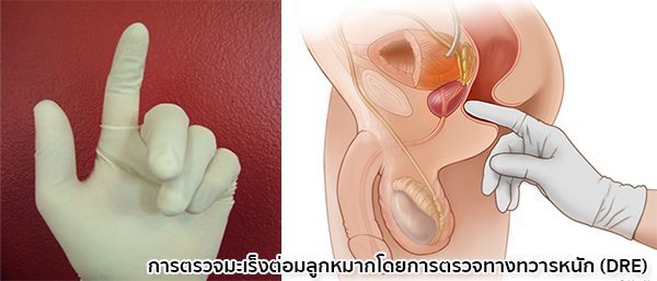 วิธีตรวจมะเร็งต่อมลูกหมาก
