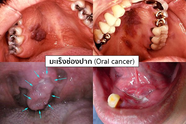 อาการมะเร็งช่องปาก