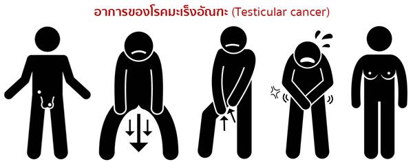 อาการมะเร็งอัณฑะ