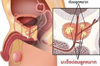 โรคมะเร็งต่อมลูกหมาก