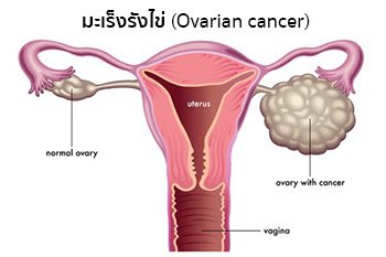 โรคมะเร็งรังไข่