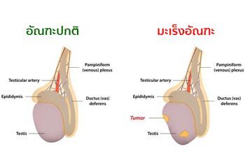 โรคมะเร็งอัณฑะ