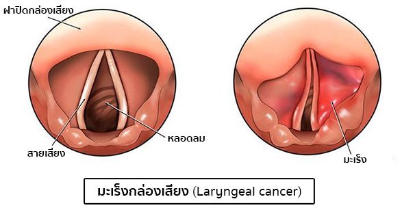 มะเร็งกล่องเสียง อาการ สาเหตุ และการรักษาโรคมะเร็งกล่องเสียง 7 วิธี !