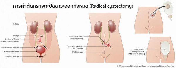 การรักษามะเร็งกระเพาะปัสสาวะ