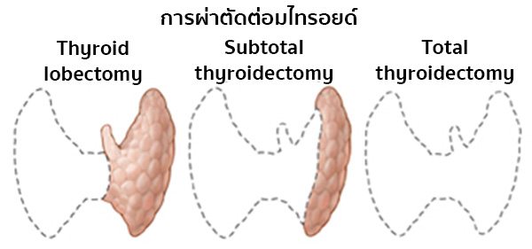 ผ่าตัดมะเร็งไทรอยด์