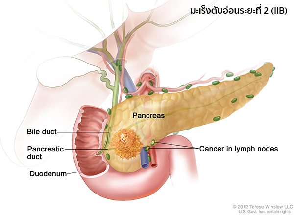 มะเร็งตับอ่อนระยะ2