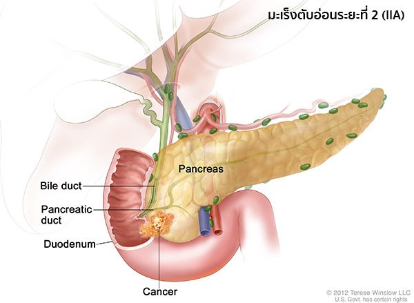 มะเร็งตับอ่อนระยะที่2