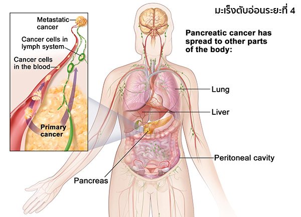 Cáncer páncreas metástasis hígado esperanza vida