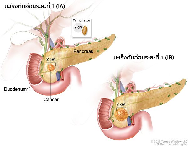 มะเร็งตับอ่อนระยะแรก