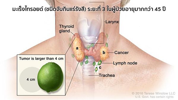 มะเร็งไทรอยด์ระยะที่3