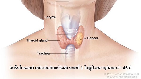 มะเร็งไทรอยด์ระยะแรก
