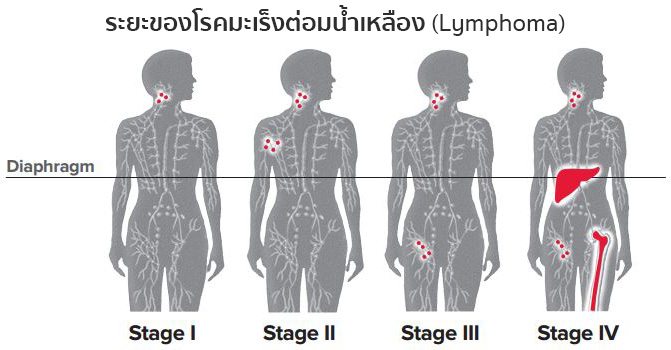 ระยะมะเร็งต่อมน้ำเหลือง