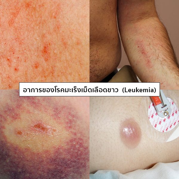 อาการมะเร็งเม็ดเลือดขาว