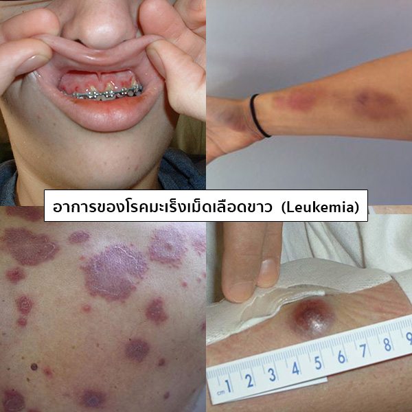 อาการลูคีเมีย