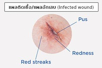 แผลอักเสบ