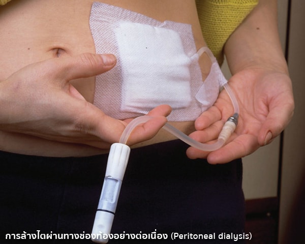 การรักษาโรคไตวายด้วยการล้างไตผ่านทางช่องท้องอย่างต่อเนื่อง (Peritoneal dialysis)