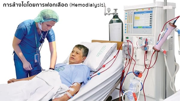 การรักษาไตวายด้วยการล้างไตโดยการฟอกเลือด
