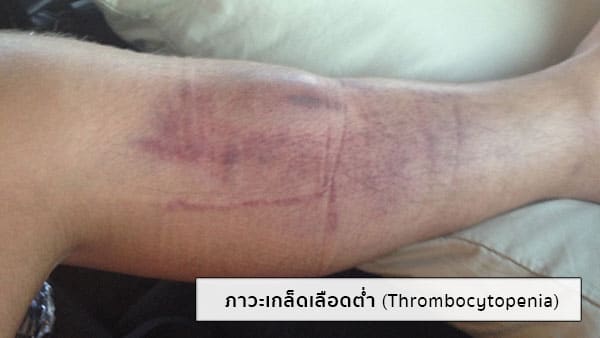 วิธีรักษาเกล็ดเลือดต่ำ