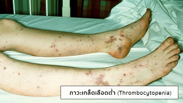 อาการเกล็ดเลือดต่ำ