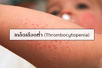 เกร็ดเลือดต่ำ