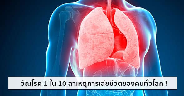 วัณโรค / วัณโรคปอด (Tuberculosis) อาการ, สาเหตุ, การรักษา ฯลฯ