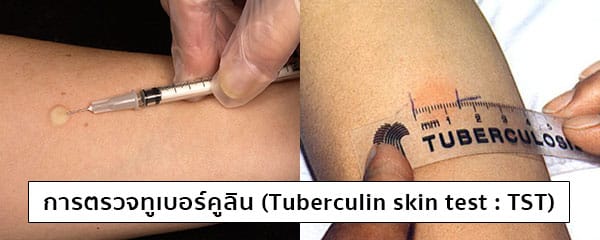 การตรวจคัดกรองวัณโรค