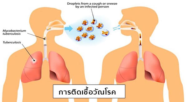 วัณโรคติดต่อทางไหนบ้าง
