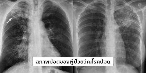 อาการของวัณโรคปอด