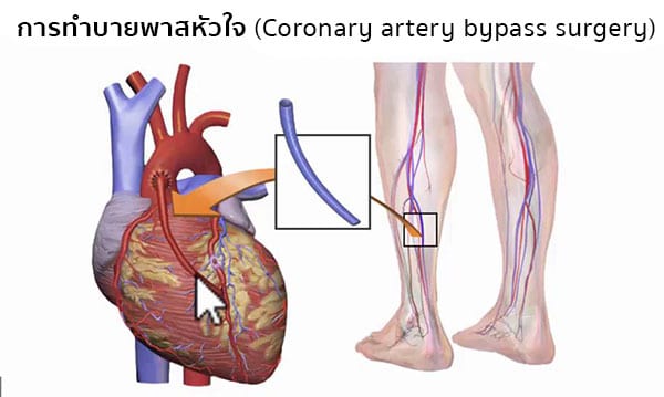 การทำบายพาสหัวใจ