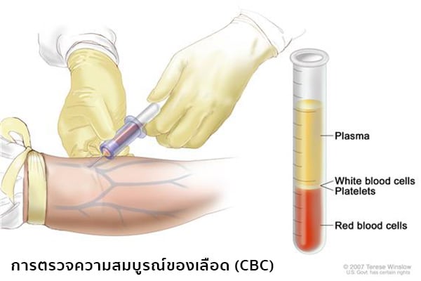 cbcคืออะไร