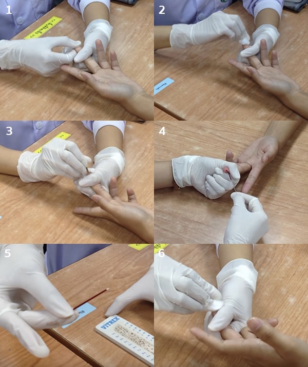 การตรวจระดับน้ำตาลในเลือด