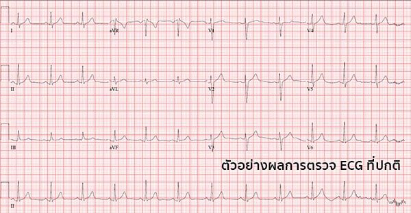 ผลการตรวจคลื่นไฟฟ้าหัวใจ