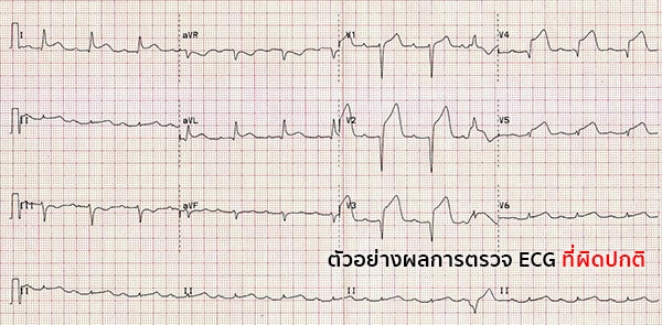 ผลตรวจคลื่นไฟฟ้าหัวใจ