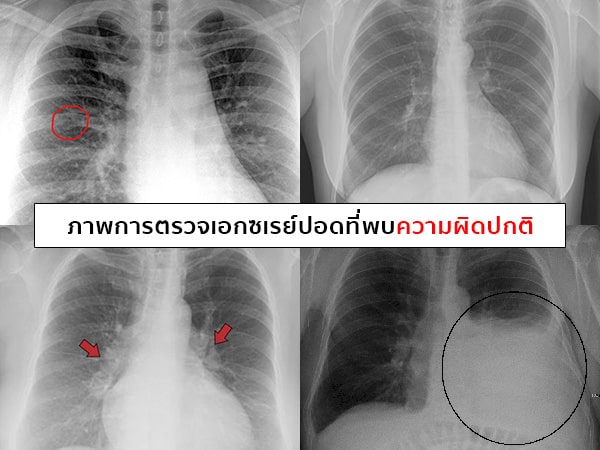 ฟิล์มเอกซเรย์ปอด