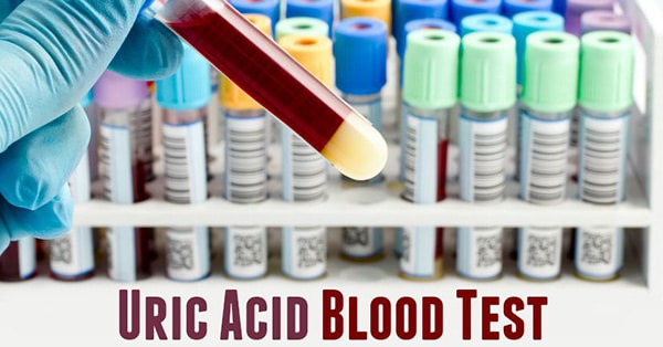 การตรวจกรดยูริก (Uric acid) ในเลือด คืออะไร ?