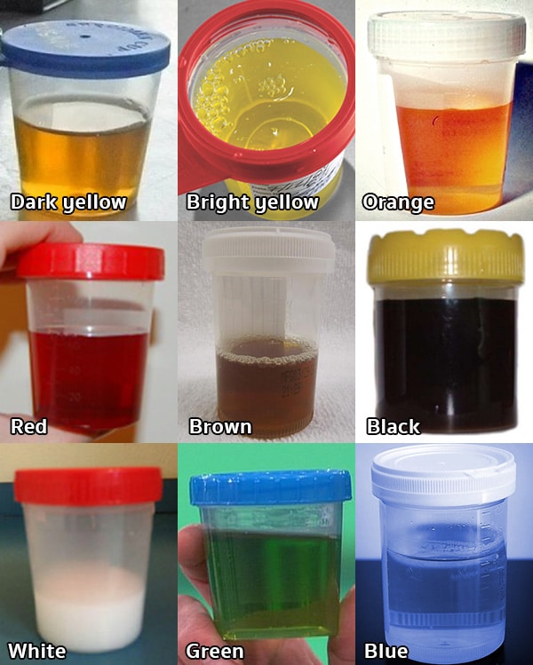 สีของปัสสาวะ (Urine Color) ปัสสาวะแต่ละสีบ่งบอกโรคที่ต่างกัน !