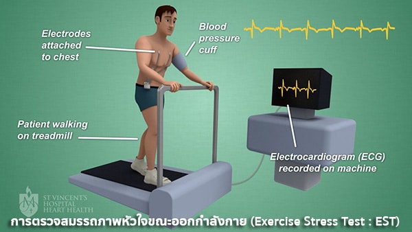 การตรวจ Exercise Stress Test