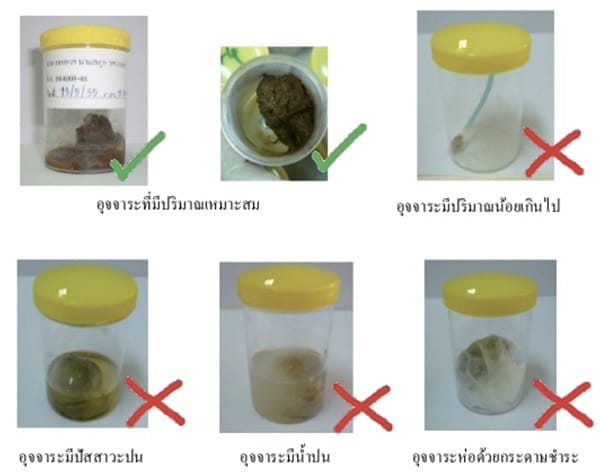 วิธีเก็บตัวอย่างอุจจาระเพื่อส่งตรวจ