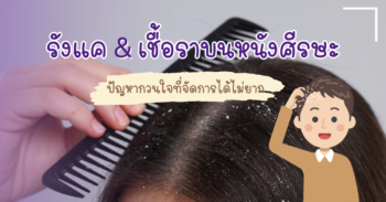 รักษารังแคและเชื้อราบนหนังศีรษะ