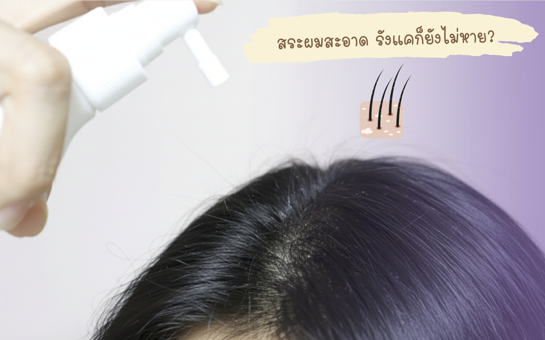 รังแคและเชื้อราบนหนังศีรษะ รักษาด้วย คีโตโคนาโซล (Ketoconazole) 2%