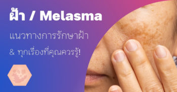 ฝ้า (Melasma) กับแนวทางการรักษาโดยแพทย์ผิวหนัง
